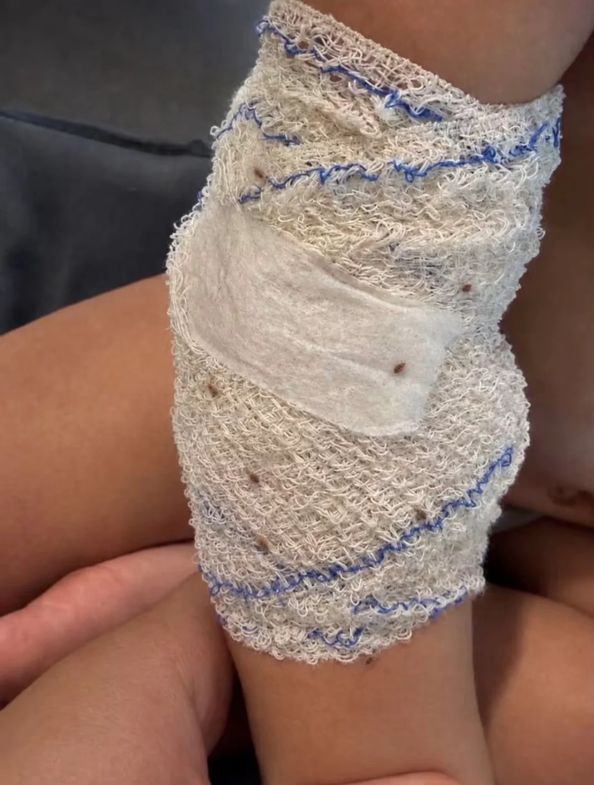 Bandage photographié par la mère de l’enfant, avec plusieurs insectes qu’elle présente comme des punaises de lit.